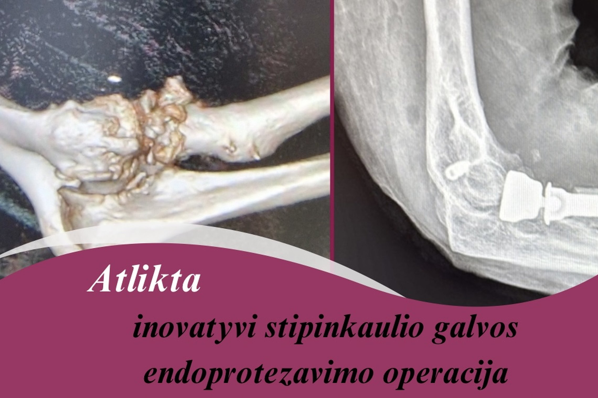 Pristatome dar vieną inovatyvią operaciją atliktą būtent mūsų Ligoninėje