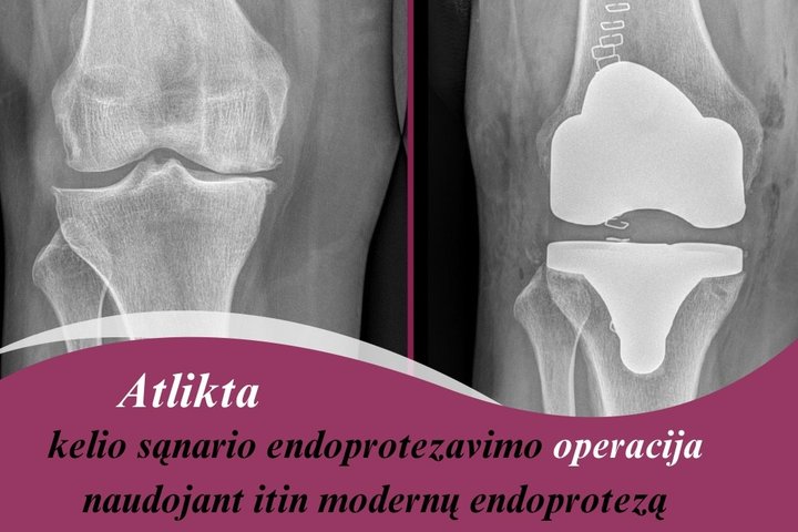 Atlikta kelio sąnario endoprotezavimo operacija naudojant itin modernų endoprotezą